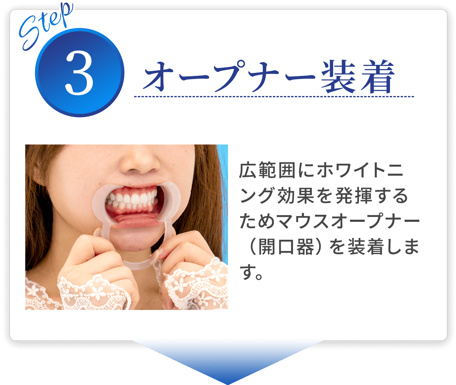 step03 オープナー装着 広範囲にホワイトニング効果を発揮するためマウスオープナー（開口器）を装着します。